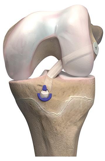 OrthoPediatrics ACL Anterior Cruciate Ligament Reconstruction System