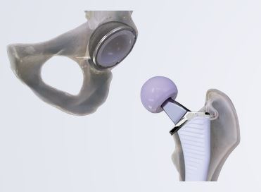 Cordera Match Hip Replacement System