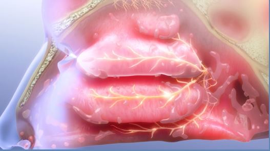 Neuromark Rhinitis Treatment System