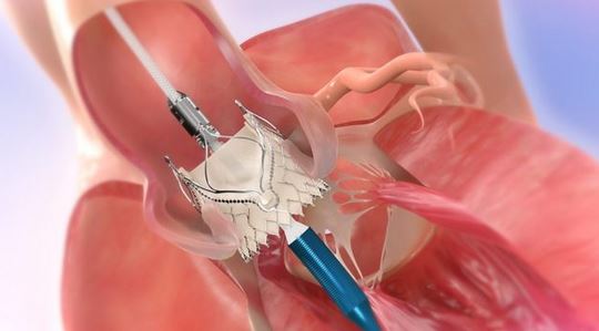 Jenavalve - Physicians - Jenavalve TAVR System - Transcatheter Heart ...