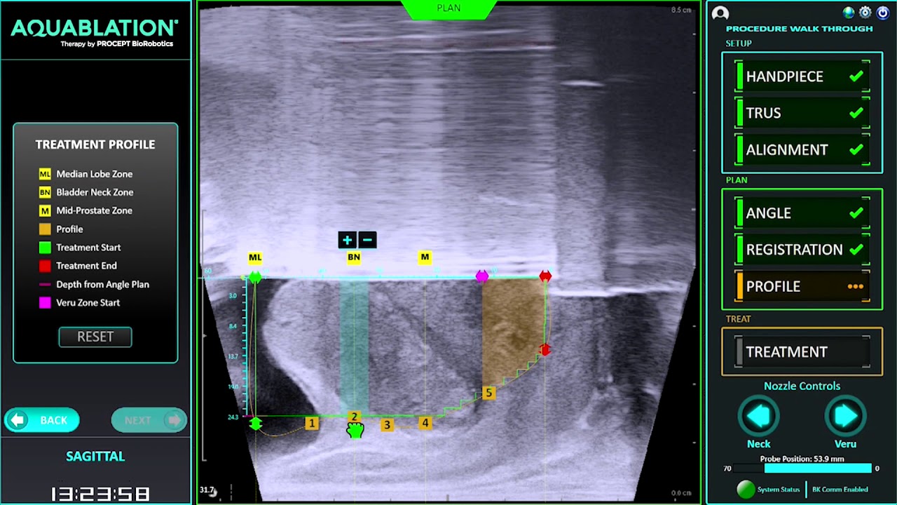 AquaBeam Robotic System - Personalized Treatment Planning,