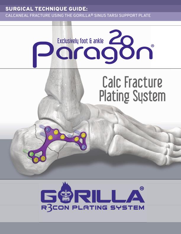 Calc Fracture Plating System Surgical - Technique Guide