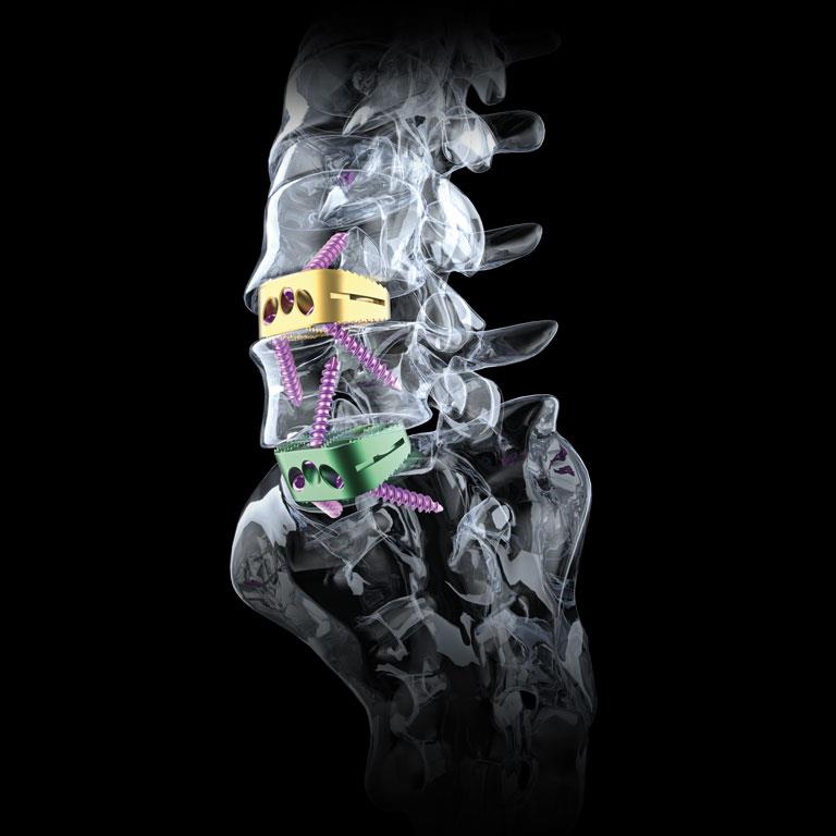 Cobra Spinal Solutions Anterior Lumbar Interbody Fusion