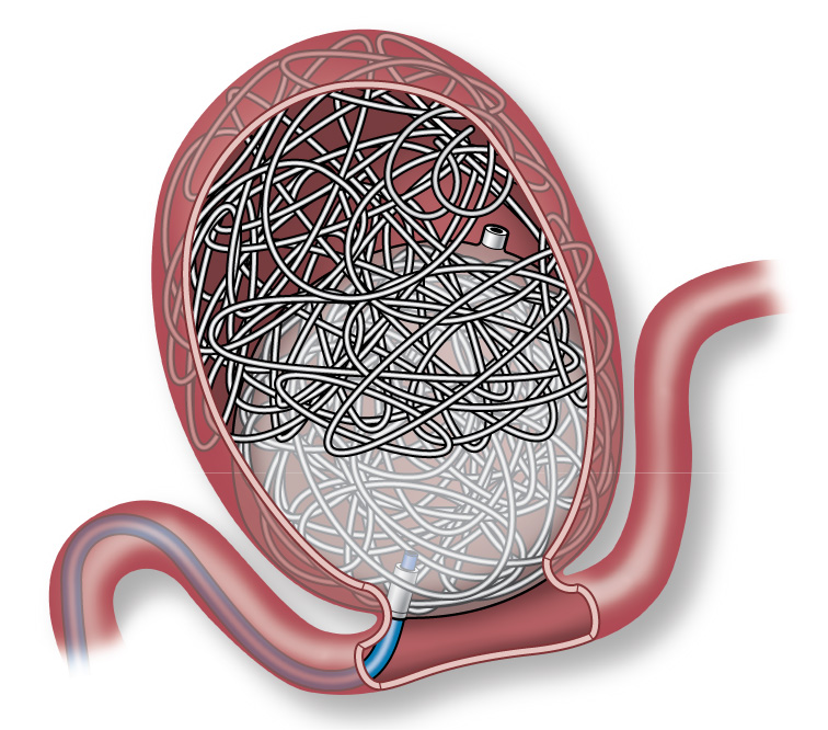 Aneura Embolization Device