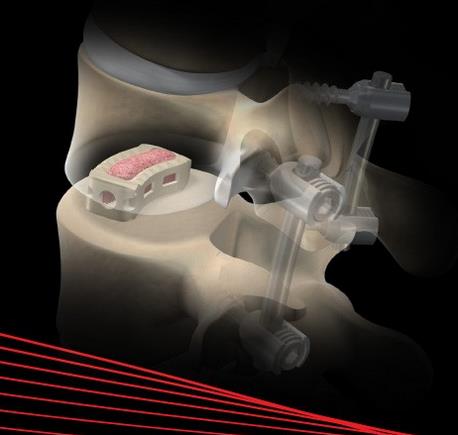 Alamo T Transforaminal Lumbar Intervertebral Device