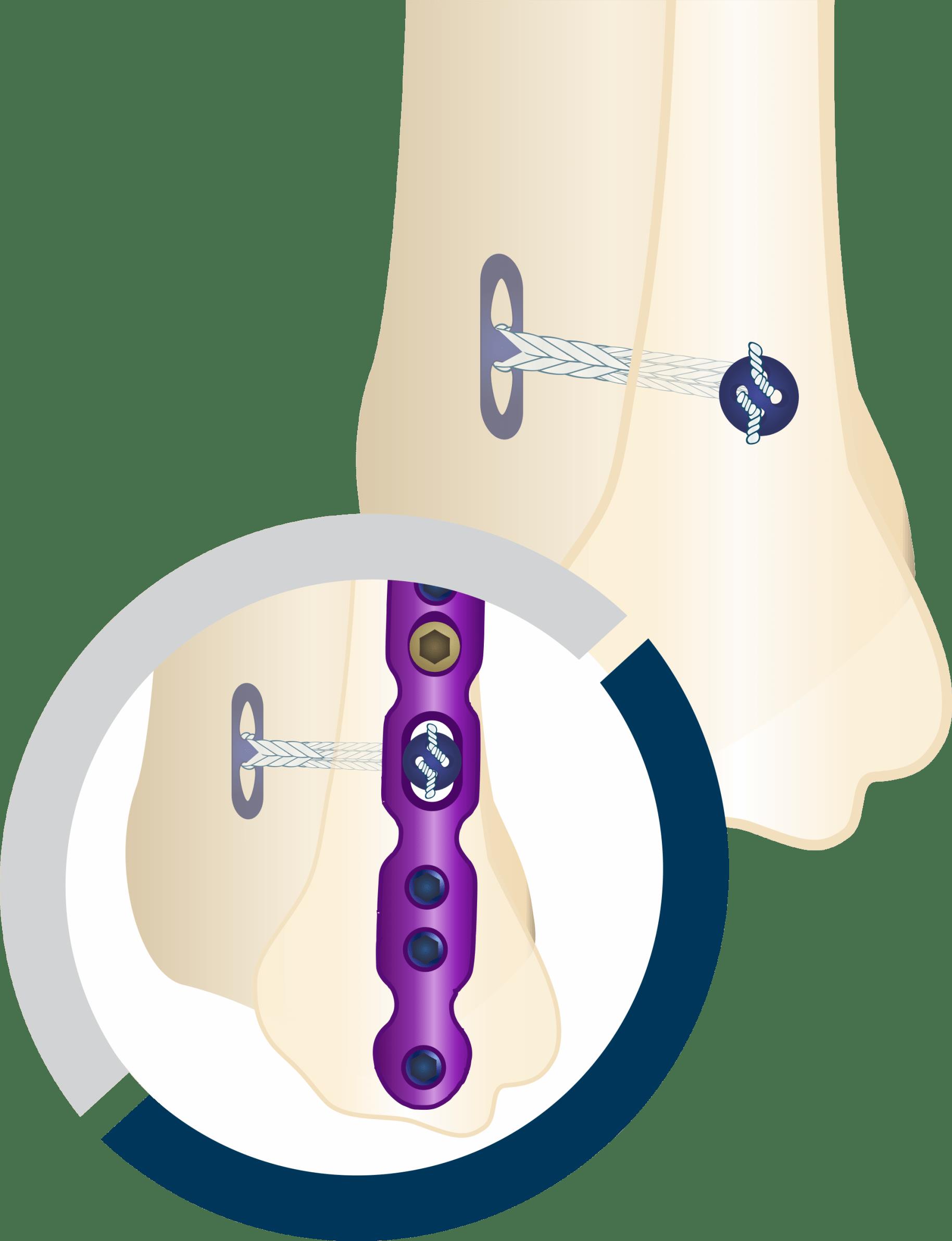 Sports Medicine Expert Knotless Flexible Joint Fixation