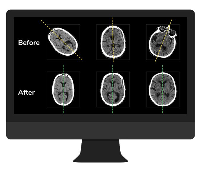 NeuroQuant CT Automated Brain Volumetrics with NeuroQuant